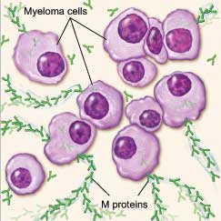 Myeloma cell (abnormal plasma cell) making M proteins.